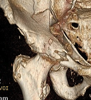 Acetabular Fracture 3D CT Anterior Column